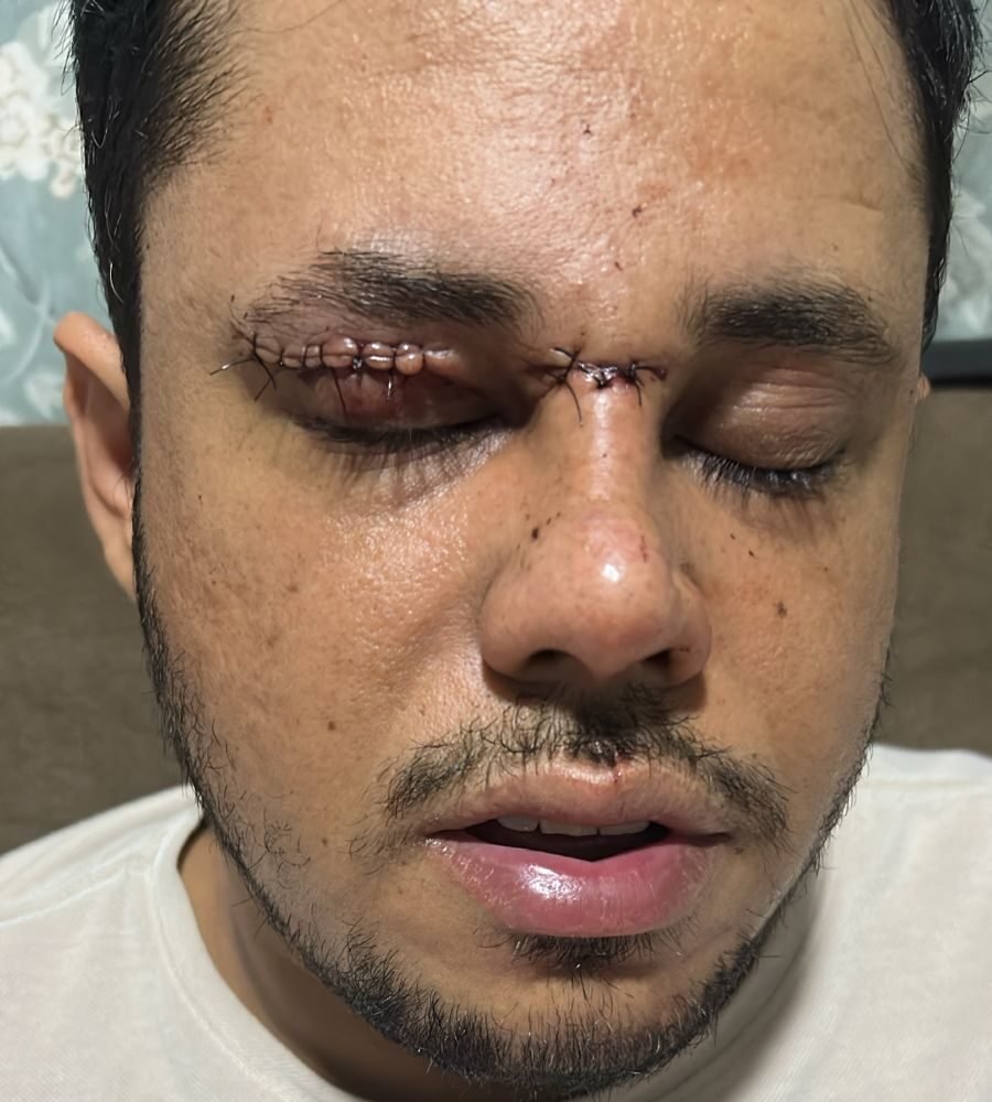 Motociclista é ferido por linha com cerol em Primavera do Leste e recebe 10 pontos no rosto